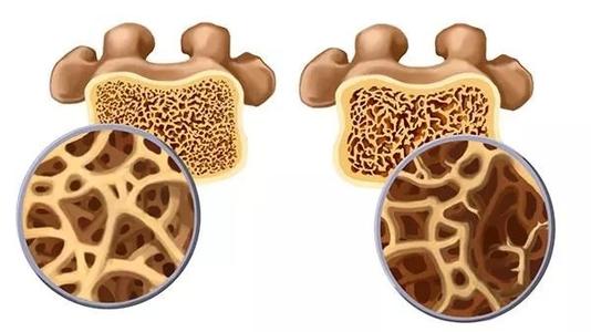 血液微量元素分析儀廠家骨質(zhì)疏松癥要吃什么？
